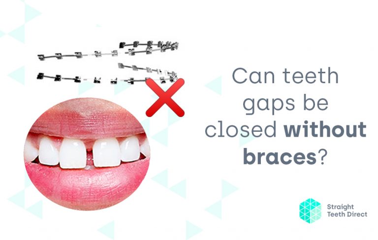 braces gaps tighten remedies
