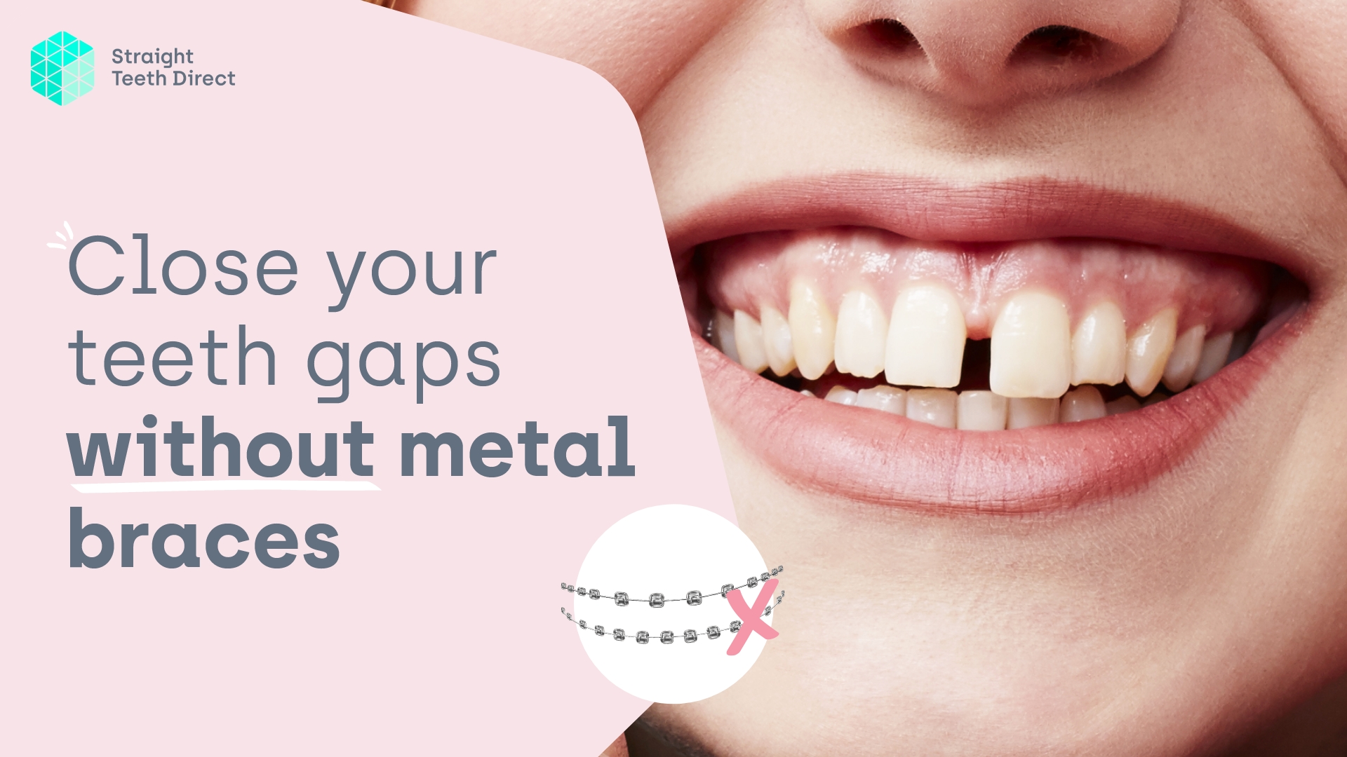 Say Goodbye to Teeth Gaps