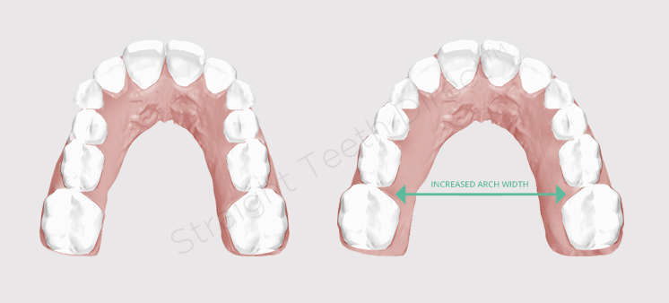 Teeth aligners: can I use them to straighten one arch only?