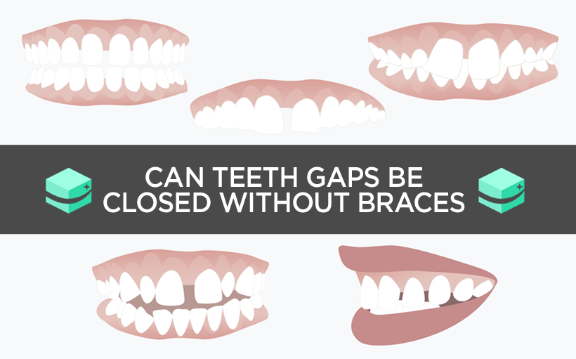 teeth straight braces