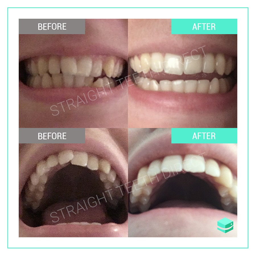 overbite aligners smile fix clear
