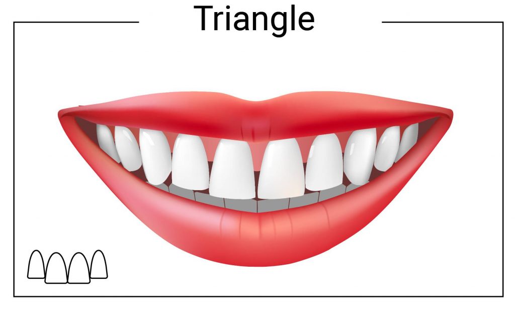 Black Triangles - Why they happen and what to do about it