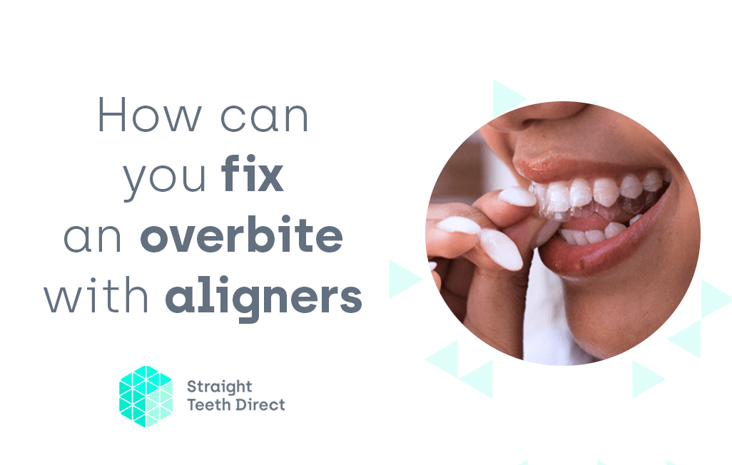 Overbite: wondering if clear aligners could fix yours?