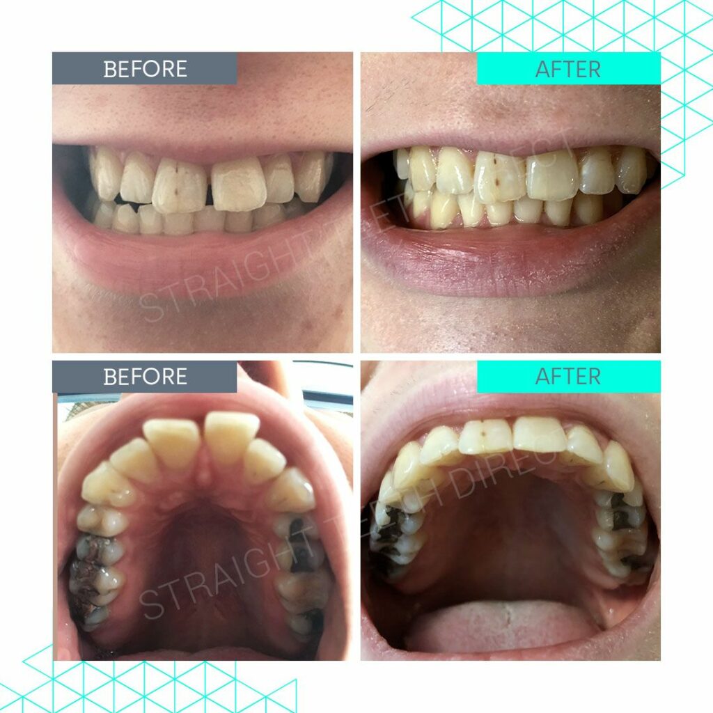 Invisible Teeth Braces - At Home Teeth Straightening Made Simple